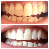 aadic kollam dental clinic - Teeth Whitening