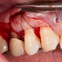 aadic kollam dental clinic - Flap Surgery