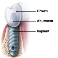 aadic kollam dental clinic - Implants