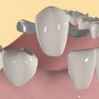 aadic kollam dental clinic - Maryland bridges